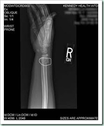 broken wrist