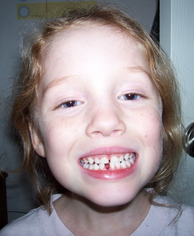 [Now she is part of the missing tooth club!2[2].jpg]