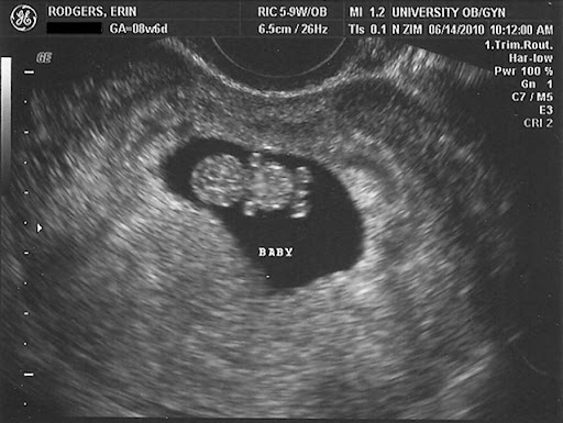 ultrasound 8 weeks. First Ultrasound: 8 weeks,