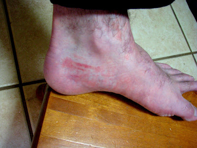 Bruised heel