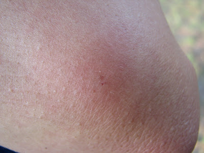 Spider Bite