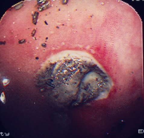 thyroid gland near ear inflamed
