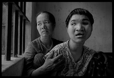 [deformed-daughter-vietnam[1][4].jpg]