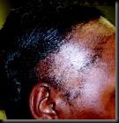 traction alopecia