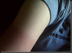 sunburn