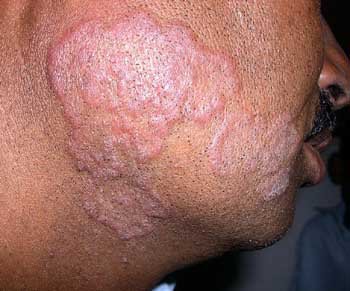 ring_worm_face-2011-01-15-14-01.jpg