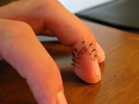 Day Five.  The edge of the laceration is becoming more defined.