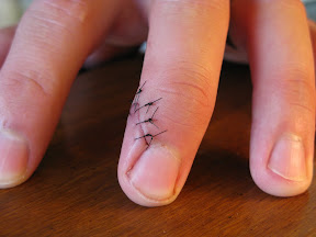 Day Five.  The swelling has gone down a bit, but the redness continues to deepen.