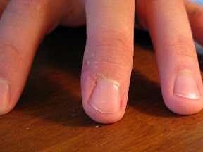 Day 16.  Outward signs are fading for the most casual observer.  I'm starting to think, in spite of the lack of blood, that the marking in the nail is full cut, rather than a mere scratch.