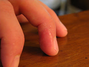 Day 16.  From this angle, the scarring is more evident.  The fingerprints, oddly enough, aren't coming back fully.