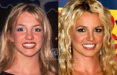 britney spears antes y despues de la cirugia plastica