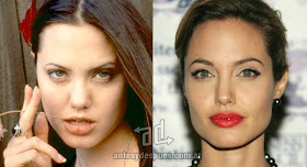 angelina jolie antes y despues de la cirugia plastica