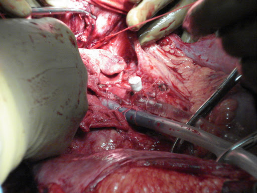 Трансплантация...