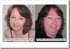 Before and after Cushings