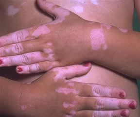[vitiligo1[4].jpg]