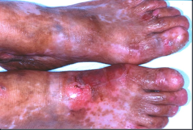 epiderm_bolhosa_04 epiderm_bolhosa_04
