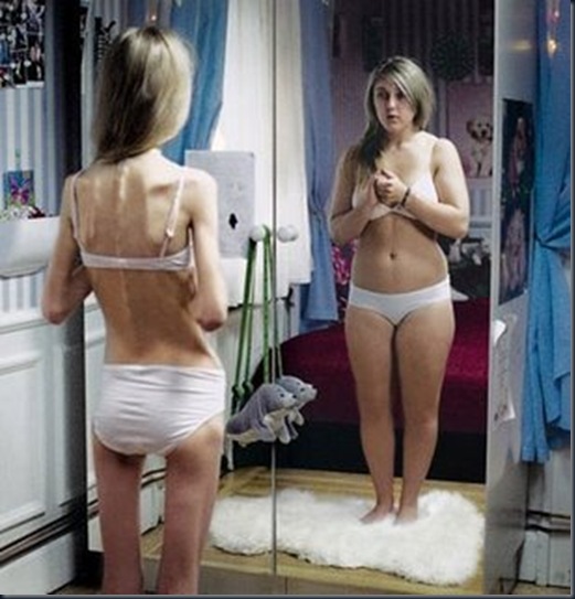 anorexia