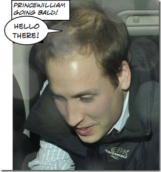 Prince William Going Bald