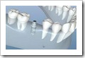 dental implan type