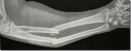 broken arm - radius and ulna x ray 10