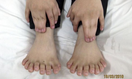 Boy With Record 31 Fingers and Toes Boy With Record 31 Fingers and Toes