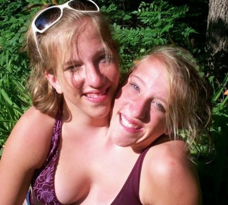 world’s oldest living conjoined twins world’s oldest living conjoined twins