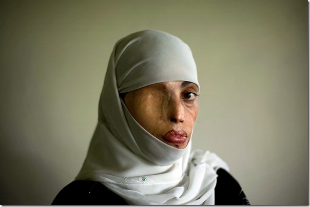 DOMESTIC VIOLENCE IN PAKISTAN. Irum Saeed, 30, poses for a photograph at her office at the Urdu University of Islamabad, Pakistan, Thursday, July 24, 2008. Irum was burnt on her face, back and shoulders twelve years ago when a boy whom she rejected for marriage threw acid on her in the middle of the street. She has undergone plastic surgery 25 times to try to recover from her scars. Photo/Emilio Morenatti