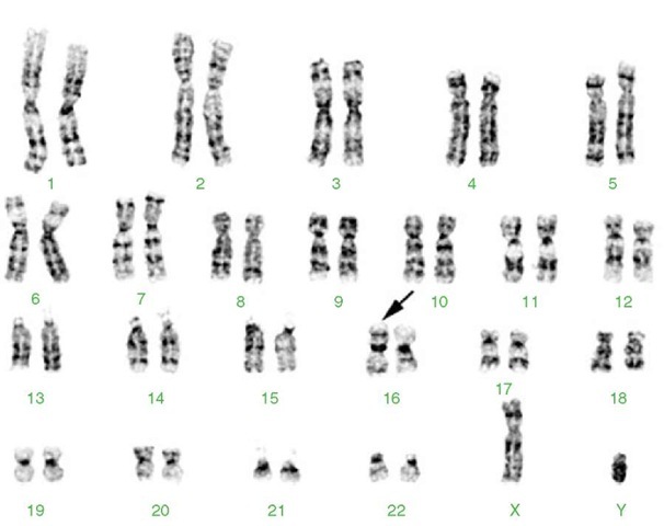 Karyotype from a 10-year-old female with acute myeloid leukemia (AML) with abnormal bone marrow eosinophils and the characteristic inverted chromosome 16 (arrow). This inversion results in a fusion between CBFB on the long arm that codes for a subunit of a DNA binding protein complex and the MYH11 gene on the short arm that codes for the smooth muscle form of myosin heavy chain protein. The fusion protein is thought to interact with the AML1 transcription factor and increase its ability to bind to DNA and regulate transcription. 46,XX,inv(16)(p13q22) 
