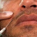 dermal_filler_1