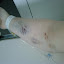 My bruised up arm from all the needles over the last week.