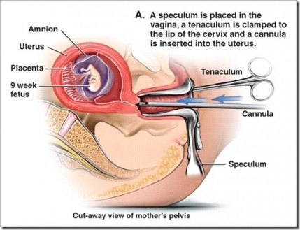 abortion11