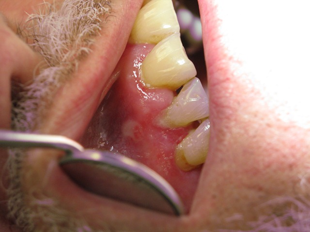 [GumDisease[1].jpg]