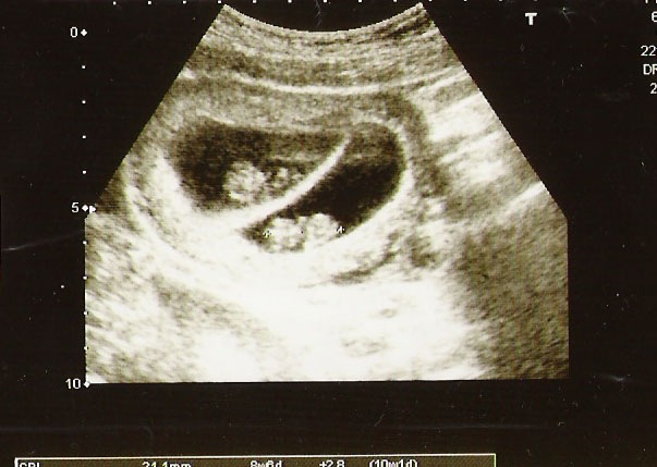 [babies 9 weeks crop[5].jpg]