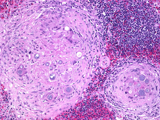 splenomegaly with enlarged pituitary gland with fluid in pelvis splenomegaly with enlarged pituitary gland with fluid in pelvis