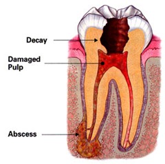 root-canal-abscess