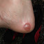 Yates reveals one of his larger blisters