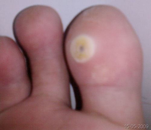 [2009-05-15 - toeCorn[3].jpg]