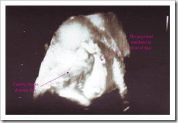 31 Week Ultrasound_labeled