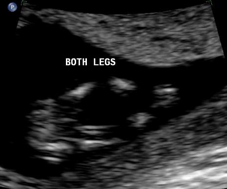 [2009-07-06 both legs[2].jpg]
