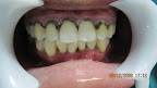 มารู้จักหินปูน (Dental Calculus) กันเถอะครับ
