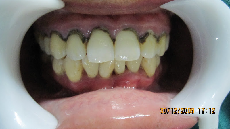 dental calculus