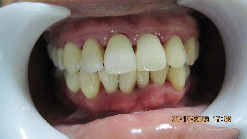 after remove dental calculus