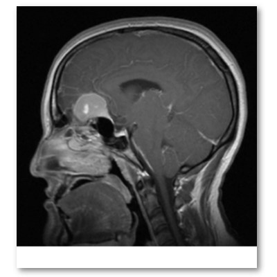 meningioma