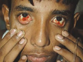 Dengue haemorhagic fever