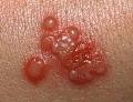 Herpes