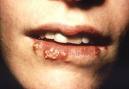 Herpes oralis