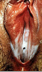 ตกขาว คันช่องคลอด…จาก เชื้อ ทริโคโมแนส