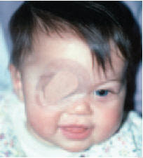 amblyopia