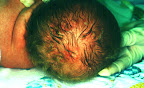 การติดเชื้อเริมในทารกแรกเกิด (Neonatal Herpes Simplex Virus Infection)