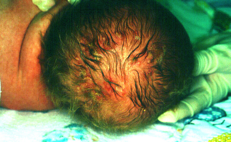 Neonatal HSV